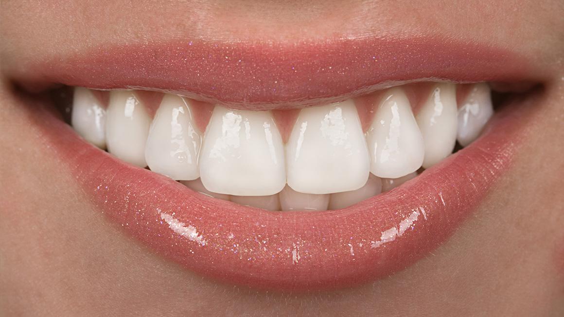 Gummy Smile Behandlung