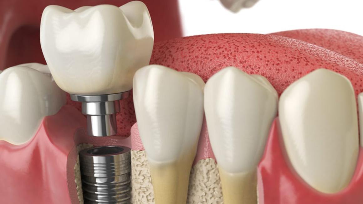 Dental Implant Treatment